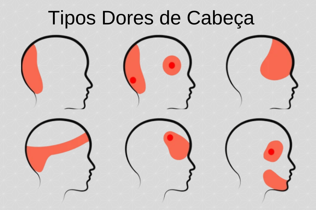 Dor De Cabeça Iconheça Os 4 Principais Tipos De Dor De Cabeça 8628